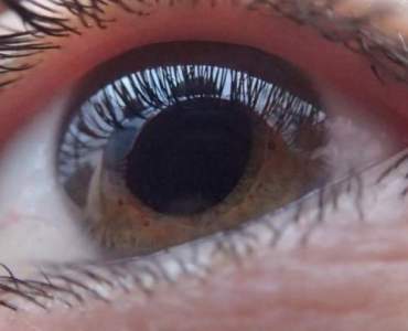 Co to jest jaskra? Objawy, przyczyny i metody leczenia