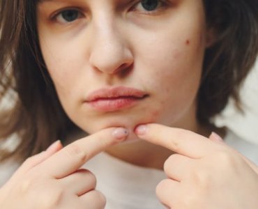 Przyczyny trądziku na twarzy – mapa twarz: co oznaczają zmiany i jak je interpretować